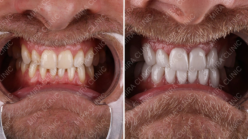 Teeth Whitening Treatment at Mira Clinic